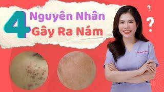 Tiết Lộ 4 Nguyên Nhân Gây Ra Nám Da Mặt | Dr Nhung