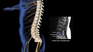 Spinal Injury Animation
