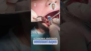 Установка импланта. Implant installation.