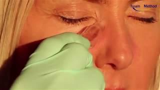 How to treat blocked tear ducts with cupping / vacuum pressure