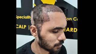 Unbelievable Hair Transplant Results in 5Months | Best Hair Transplant in India | HSN Bangalore