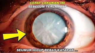 Lakukan Ini Di Rumah Agar Mata Kamu Tidak Katarak