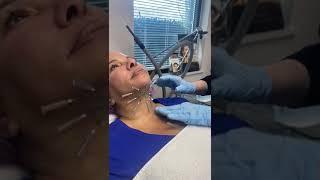 PDO Threads to tighten and lift neck - nonsurgical neck lift by Dr. Pamela Kulback