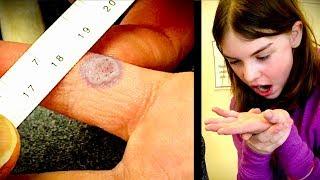 DEEP FREEZING a PAINFUL PINKY WART! (with liquid nitrogen) | Dr. Paul