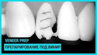 Veneer prep. Препарирование под винир