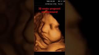 SIÊU ÂM THẢO HIỆP YÊN PHỤ YÊN PHONG BẮC NINH/35 weeks pregnant on ultrasound