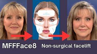 EFFFace8 | Non-Surgical FaceLift | Non-Surgical FaceLift Before and After