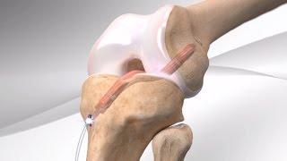 All-Inside ACL Reconstruction with Arthrex® GraftLink®