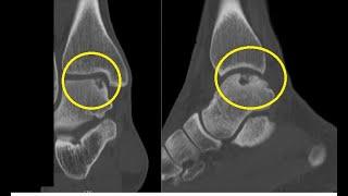 Osteochondral Defects of Talus