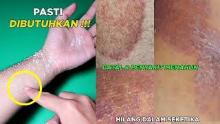 Obat Gatal Alami Pada Kulit Yang Paling Ampuh & Cepat Hilang