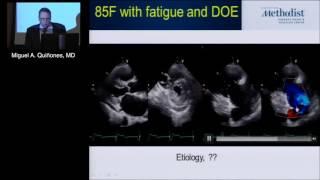 RV Dysfunction with TR: Watch, Wait, Then What? (Miguel A. Quinones, MD) April 29, 2016