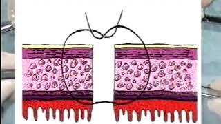 9.1. End to End Bowel Anastomosis - Interrupted [Basic Surgery Skills]