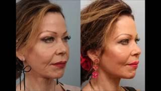 Female Revision Facelift Necklift Before and After  Dr. Edwin Williams