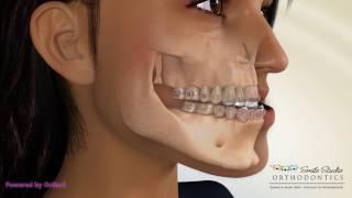 BSSO Mandibular Setback - Transcortical With Face