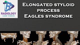 Elongated styloid process  - Eagles syndrome