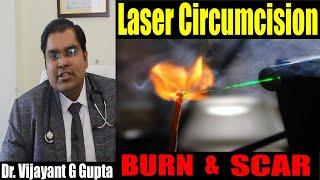 The Reality of Laser Circumcision - A systematic review of harms