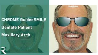 Full Arch Guided Surgery with CHROME GuidedSMILE: Dentate patient, maxillary arch