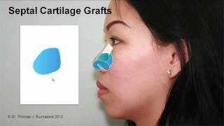 Septal Cartilage Grafts Case Study Part 1 | Asian Rhinoplasty with Dr. Buonassisi in Vancouver BC