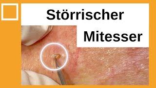 Störrischer Mitesser entfernt. Dr. Kasten Hautmedizin in Mainz