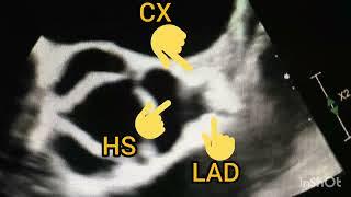 Left main stem with it's bifurcation into LAD and CX clearly seen in TEE.