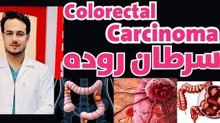 سرطان روده یا Colorectal Carcinoma چیست و چگونه بوجود می‌آید ؟ #داکترنویدخپلواک