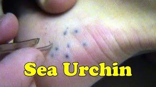 Sea Urchin Spine Sting Removal Attempt - Maui Hawaii - Daredevil Girl