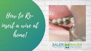 How to re-insert a wire at home - Wheaton orthodontist