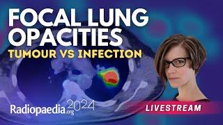 Focal lung opacities: tumour vs infection with​ Miranda Siemienowicz