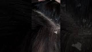 dandruff scratching addiction #98