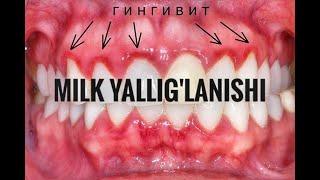 Milklarni davolash. Milklarni uy sharoitida davolash uchun retsept