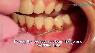 No bleeding and pain-free laser gingival depigmentation procedure performed by Pioon dental laser