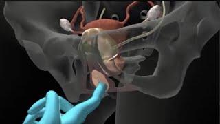 Kegel Exercises for Female Urinary Incontinence - Anatomical 3D Visualization