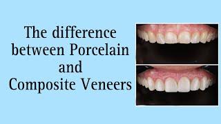 Difference between Porcelain Veneers and Composite Veneers