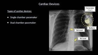 How to Interpret a Chest X-Ray (Lesson 9 - Atelectasis, Lines, Tubes, Devices, and Surgeries)