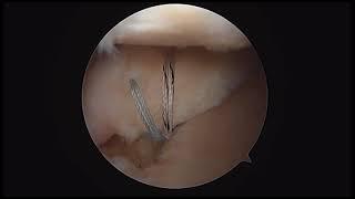 Arthroscopic Medial Meniscus Posterior Root Repair with Centralization Using Knotless Suture Anchors