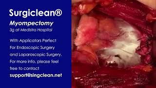 Myompectomy With Surgiclean® 3g at Medistra Hospital