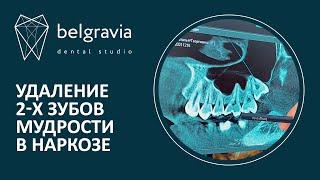 Удаление 2-х зубов мудрости в наркозе. Клинический случай