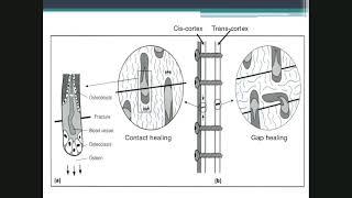 Lecture 2 Fracture healing and complications