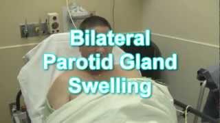 Bilateral Parotid Gland Swelling