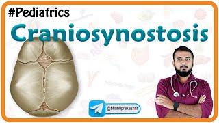 Craniosynostosis : Types, Causes, Diagnosis and Treatment : Pediatrics National exit test