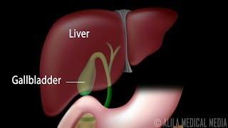 Gallstones and Surgical Removal of Gallbladder (Cholecystectomy) Animation.