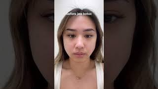 Jaw Masseter Botox Slimming Results