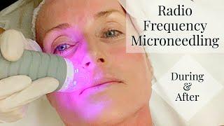 My Radio Frequency Microneedling Experience | the FULL Treatment & the Days following | Vivace RF MN