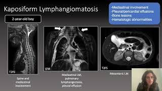 Lymphatic Anomalies in Children: Update on Imaging Diagnosis, Genetics and Treatment