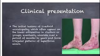 Livedoid vasculopathy, pathophysiology, clinical features, treatment and case presentation