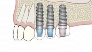 Имплантация зубов на имплантах Xive. Немецкий имплантологический центр