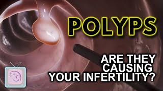 Uterine polyps: Removal for infertility?