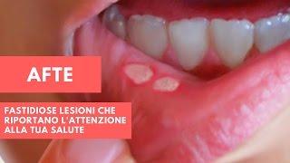 Afte | Pronto Soccorso Naturale