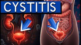 Cystitis Uncovered: The Ultimate Guide to Bladder Inflammation, Symptoms, Causes, and Treatments