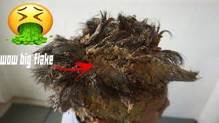 Itchy Scalp Psoriasis | Removing dandruff Flake with lice comb on Lazy boy's head #327